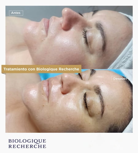 Biloguique recherche resultados lifting majadahonda